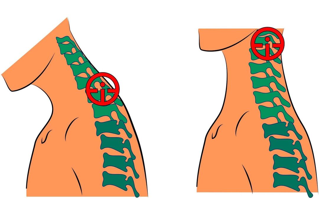 cervikální osteochondróza