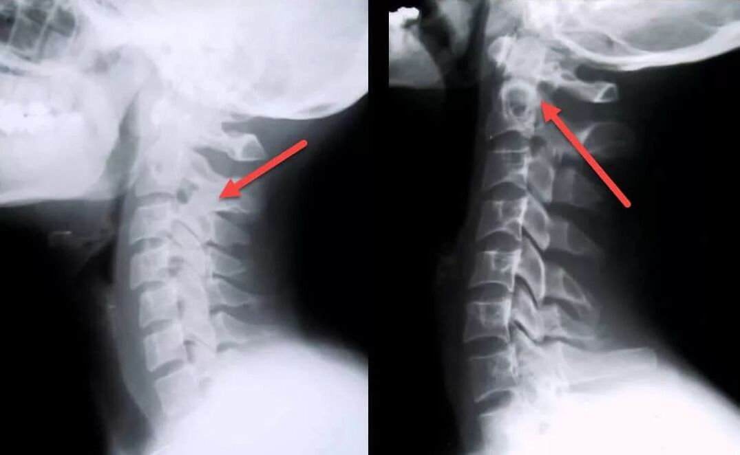 diagnostika cervikální osteochondrózy