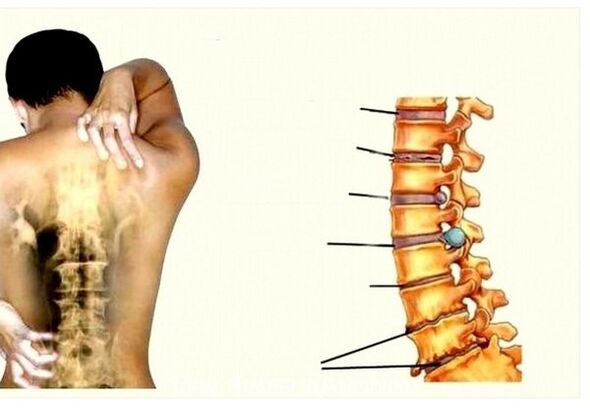 Fáze osteochondózy děložního čípku