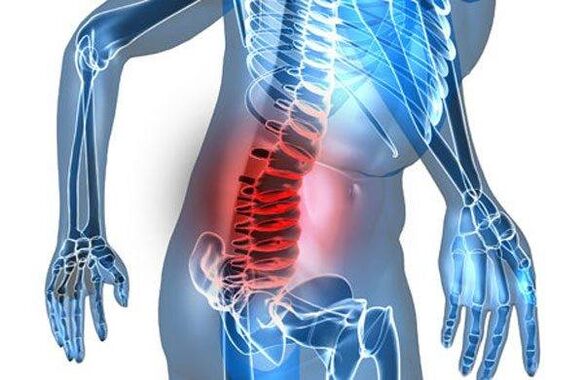 Deformita páteře ve čtvrté fázi bederní osteochondrózy