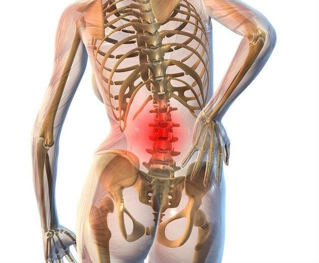 Osteochondróza bederní páteře