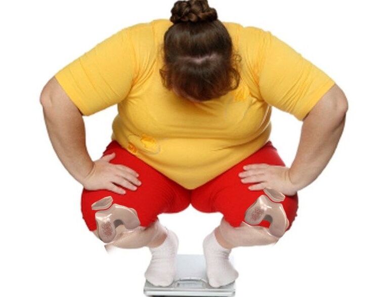 Mezi pacienty trpícími artrózou je většina pacientů s nadváhou nebo obezitou